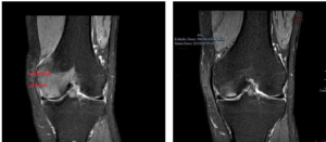 edema oseo 300x131 1